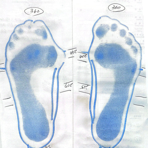 外反母趾により辛い足裏の痛みが。インソールを使用してから慢性的な腰痛も改善。