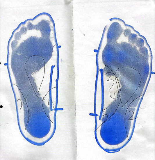 変形性膝関節症（X脚）の進行により、半月板損傷。インソールで改善。