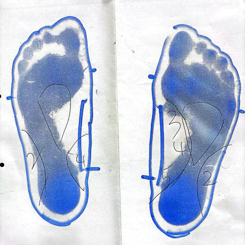 変形性膝関節症（X脚）の進行により、半月板損傷。インソールで改善。