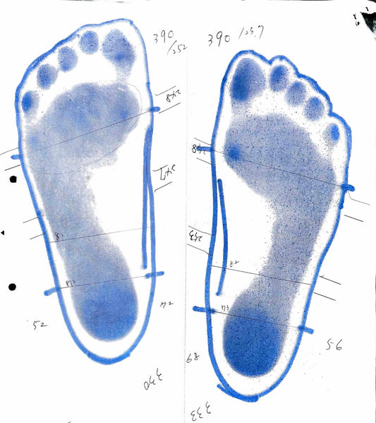 人工股関節置換術後に両膝痛でお悩み。固有受容器インソールで膝痛が改善。