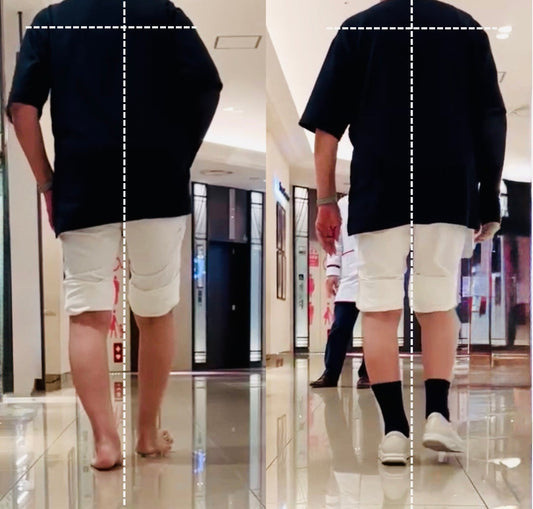 変形性膝関節症による膝の痛みと他疾患による足のむくみを改善