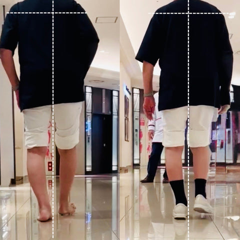 変形性膝関節症による膝の痛みと他疾患による足のむくみを改善