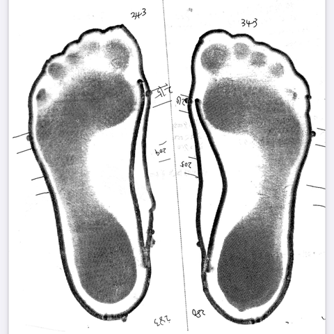 足底腱膜炎により日常生活にも支障が。アルカの室内履きで改善。
